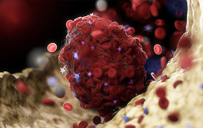  چگونه واکسن AstraZeneca باعث ایجاد لخته می‌شود؟