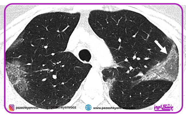 ارزش تصویر برداری پزشکی در تشخیص و ارزیابی  کووید-19